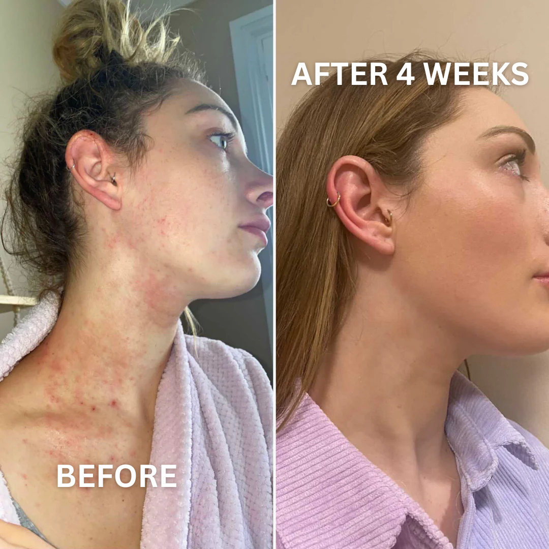 Eczema Relief Gummies